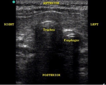 Why Point-Of-Care Ultrasound should be a mainstay for every EMS provider administering prehospital care